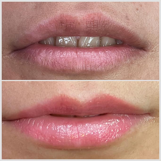 Vorher-Nachher-Vergleich einer Lippenneutralisierung