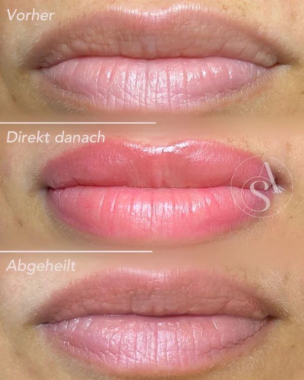 Eine feine Nadel appliziert die Farbe